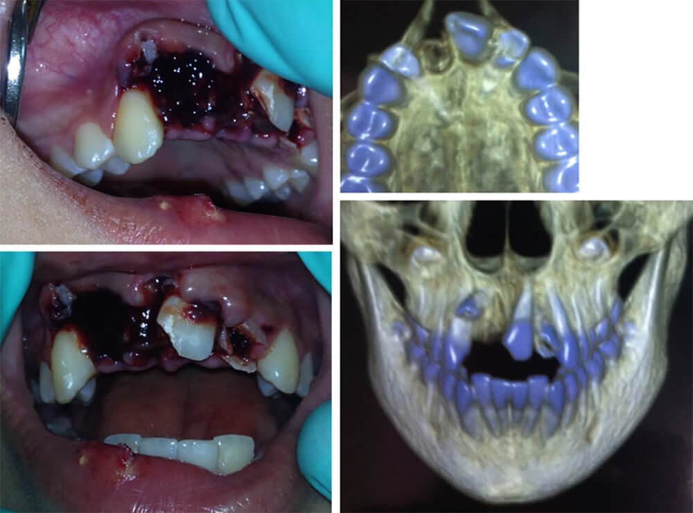 Fig 1. Imágen clínica y TAC con 3D inical mostrando avulsión, intrusión y fracturas.
