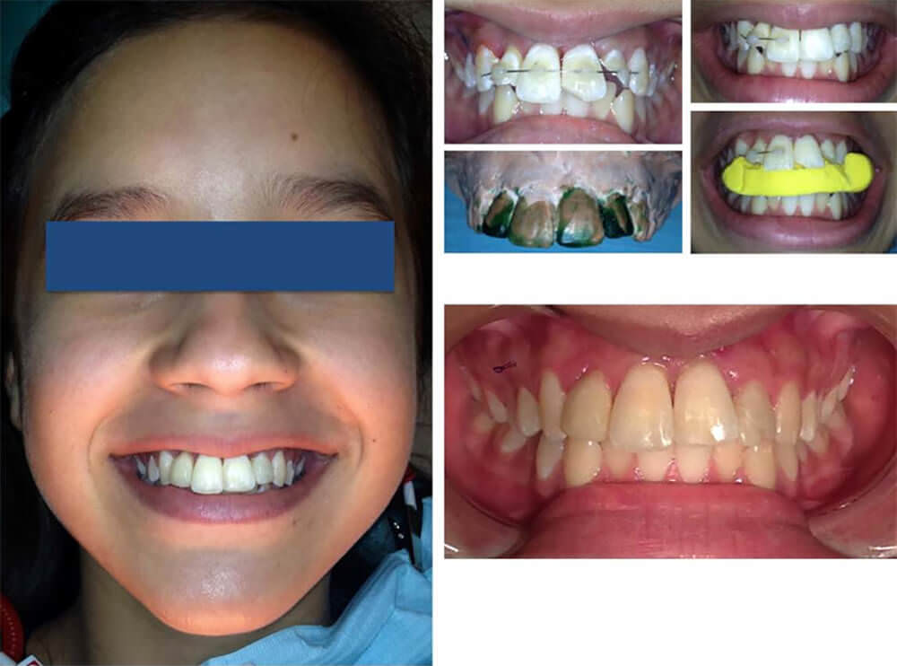 Fig 3. Imágenes clínicas de la reconstrucción de dientes fracturados y seguimiento del tratamiento a 2 años