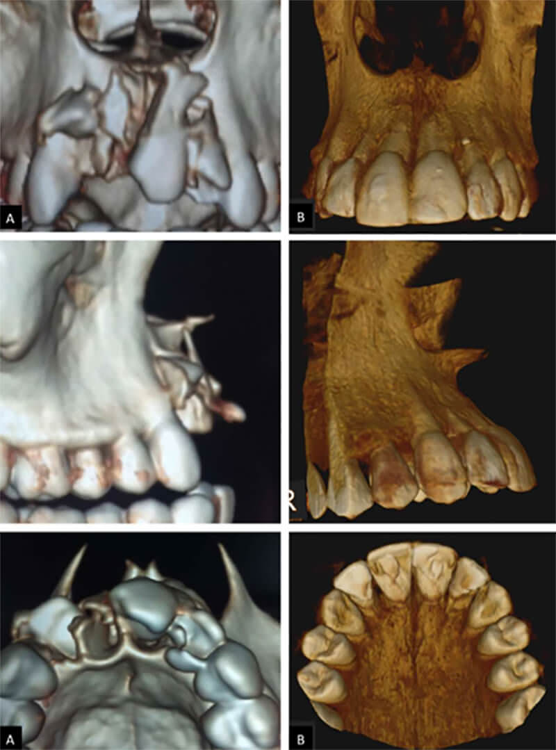 Fig 4. Reconstrucción 3D en la TAC inicial (A) y en la revaluación a los 2 años de evolución CBT (B)