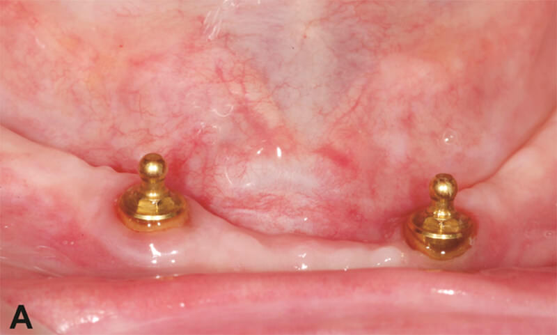Figura 1A – Sistema de retención o’ring (Neodent) sobre implantes de hexágono externo (4,0x11,0 mm).