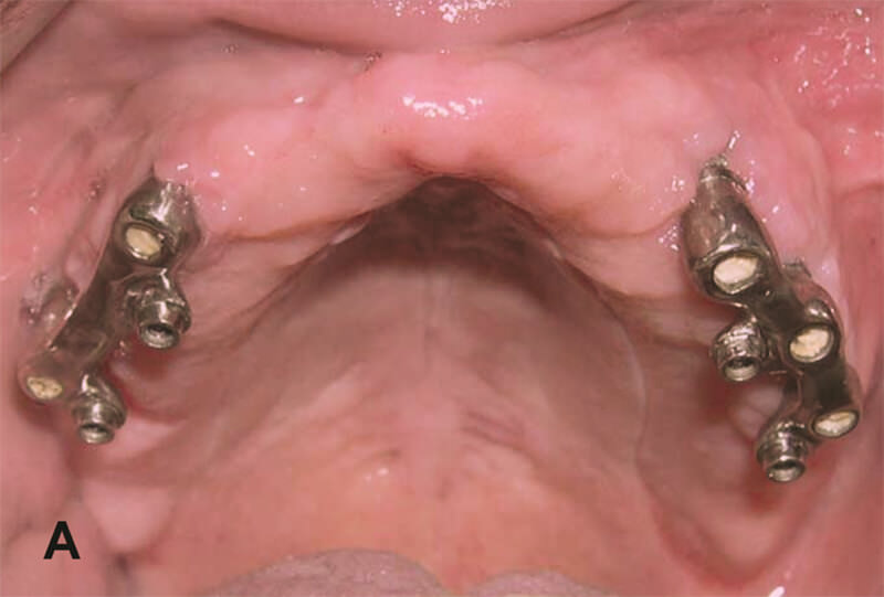 Figura 6A – Sobredentadura maxilar utilizando 5 implantes: barras discontinuas asociadas a 2 sistemas de retención de tipo ERA regular (Sterngold), lado derecho sobre 2 implantes de hexágono externo (3,75x11,0mm) (Neodent) y lado izquierdo sobre 3 implantes (2 anteriores: 3,75 x 11,0mm, y 1 posterior: 3,75 x 9,0mm).