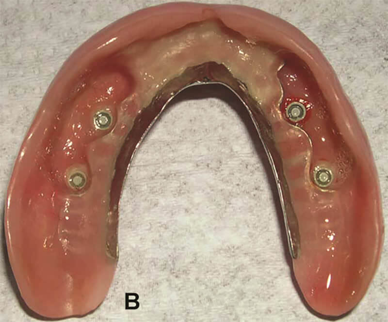 Figura 6B – Vista interna de sobredentadura maxilar con infraestructura de PPR antero-posterior y paladar abierto, mostrando las cápsulas del sistema ERA regular (Sterngold).