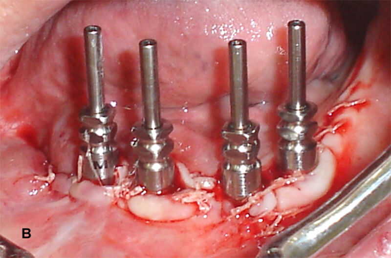 Figura 7B – Transferentes de minipilares (2mm de altura) posicionados, después de la colocación de 4 implantes (4,0x13mm, Neodent), mostrando la localización de los implantes conseguida durante la cirugía.