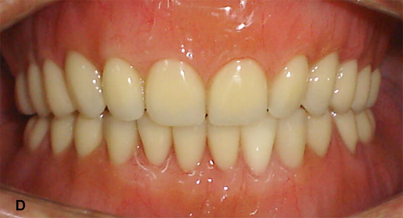 Figura 7D – Vista final: Sobredentadura mandibular sobre implantes en conjunto con una prótesis total convencional.