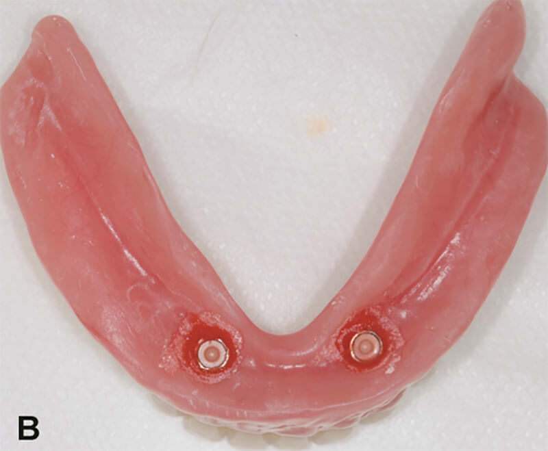 Figura 1B – Vista interna de la prótesis total inferior mostrando las cápsulas del sistema o’ring (Neodent).