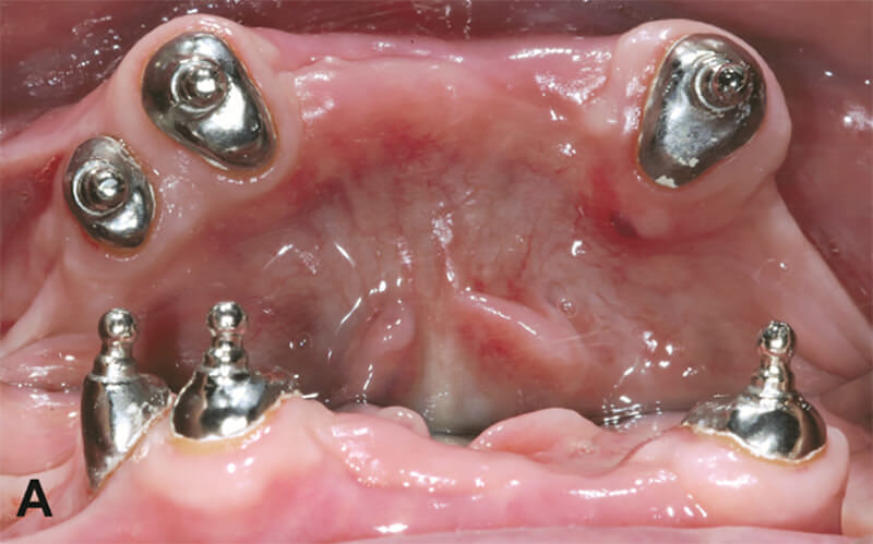 Figura 2A – Sobredentadura mandibular: vista frontal y oclusal de retenedores de tipo o’ring (Conexão) sobre raíces remanentes (33, 43 y 44).