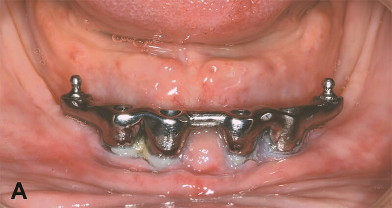 Figura 3A – Overdenture mandibular utilizando 4 implantes: barra asociada a 2 sistemas de retención del tipo o’ring (Neodent) y sistema de retención barra/clip en la región anterior (Neodent) sobre implantes de hexágono externo (4,0 x 11,0 mm) (Neodent).