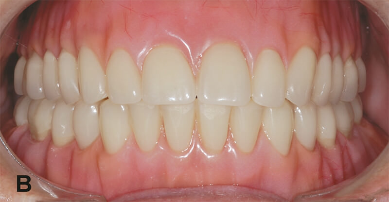 Figura 3B – Sobredentadura mandibular sobre implantes finalizada en conjunto con una prótesis total convencional.