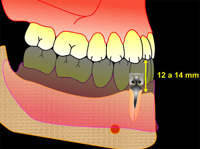 Figura 4 – Espacio interoclusal mínimo para utilización de componentes sobre implante o raíz (Misch 200726). El esquema representa arco superior con dientes naturales y sobredentadura mandibular utilizando o’ring sobre raíz de canino en vista lateral.