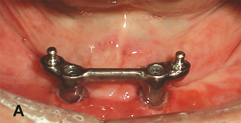 Figura 5A – Sobredentadura mandibular utilizando 2 implantes: barra asociada a 2 sistemas de retención o’ring (Conexão) y sistema de retención barra/clip en región anterior (Neodent).