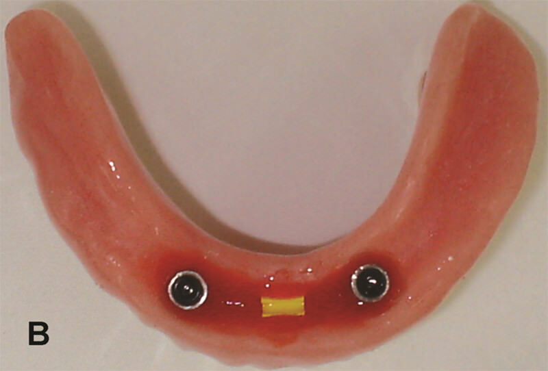 Figura 5B – Vista interna de sobredentadura mandibular mostrando las cápsulas del sistema o’ring (Conexão) y el clip plástico (Neodent) en la región anterior.