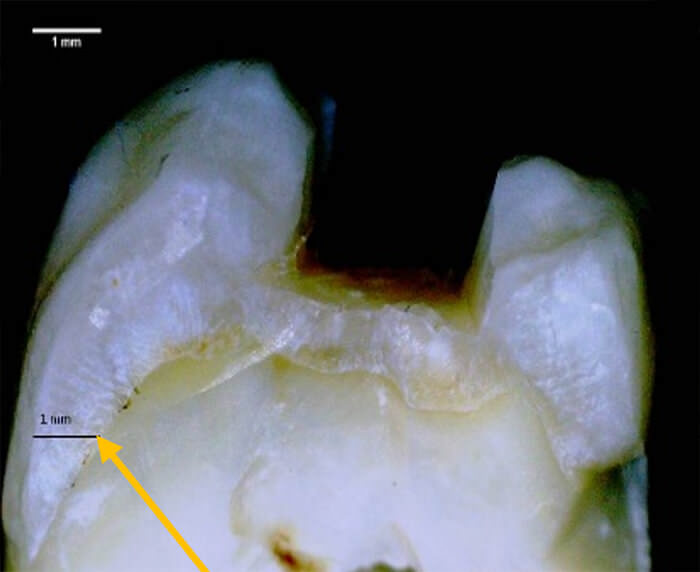 Fig. 3. Medición en mm del grosor de la capa de esmalte (pre - prueba).