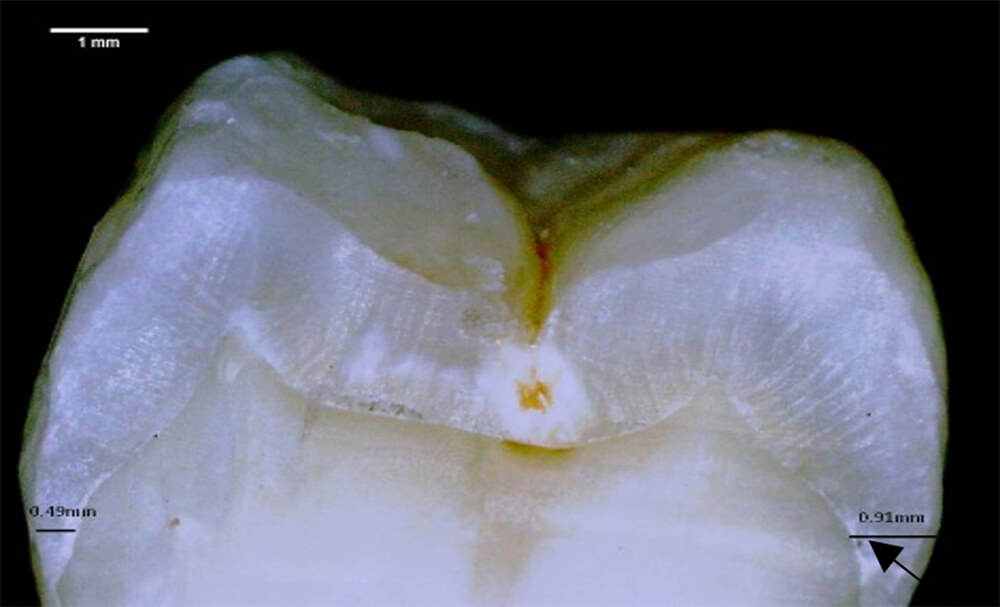 Fig. 5. Medición en mm del grosor de la capa de esmalte en diente sumergido en bebida energética (post - prueba)