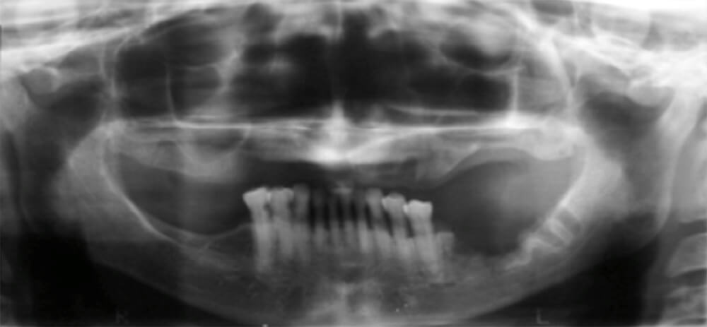 FIGURA Nº2. EXAMEN RADIOGRÁFICO PACIENTE CON ONM ASOCIADO A ÁCIDO ZOLEDRÓNICO EN MANDÍBULA