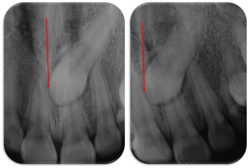 Figura 3 (radiografías periapicales Ortoradial y Distoradial)