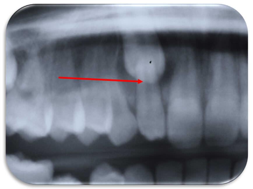 Figura 5 (Radiografía panoramica 1.3 retenido)
