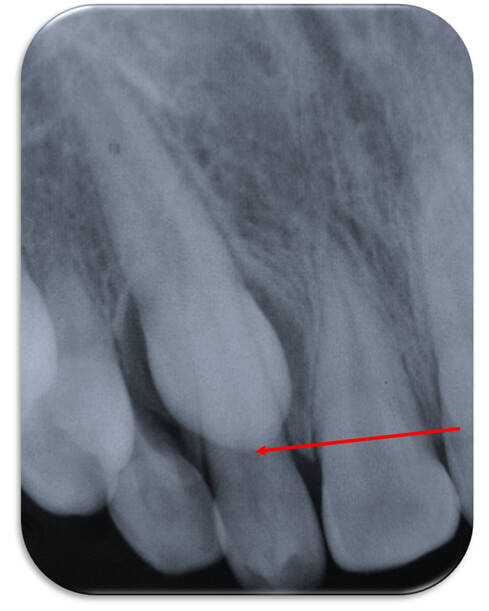 Figura 6 (Radiografia Periapical 1.3 retenido)