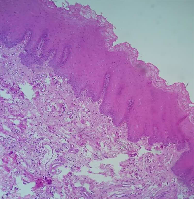 Figura 1. Microfotografía de mucosa bucal teñida con H&E 40X, donde se observa un epitelio plano estratificado paraqueratinizado de espesor aumentado (acantosis).