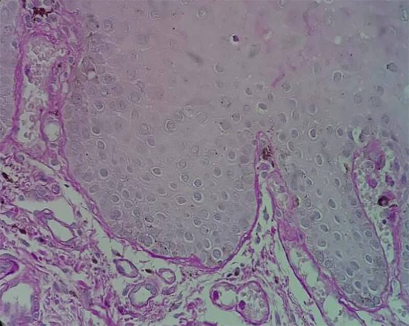 Figura 2. Microfotografía de mucosa bucal teñida con PAS a un aumento de 40X, donde se aprecia un engrosamiento moderado de la membrana basal.