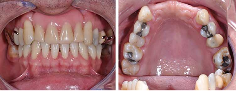 Figura 1 - Prótesis parcial removible y aspectos de normalidad de los tejidos periodontales de la región anterior del maxilar. Vista inicial de la sonrisa (1A), vista oclusal sin la protesis parcial removible (1B).
