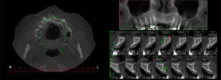 Figura 2 – Tomografia evidenciando atrofia ósea en la región edentula. Corte axial tomográfico (2A), corte sagital tomográfico (2B).