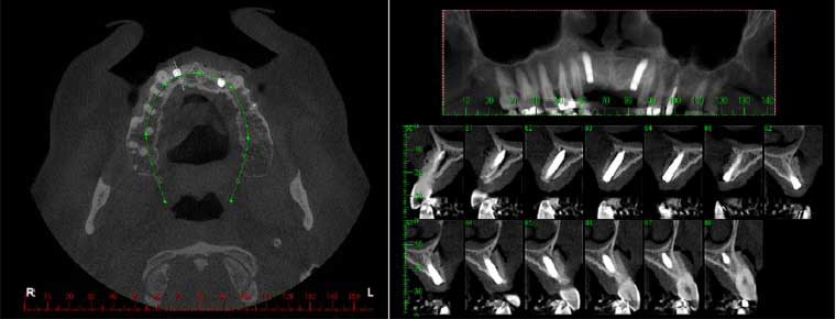 Figura 4 – Control tomográfico inmediatamente después de la cirugía de regeneración ósea guiada (ROG) y la instalación simultánea de implantes dentales. Vista corte axial (4A) vista corte sagital (4B).