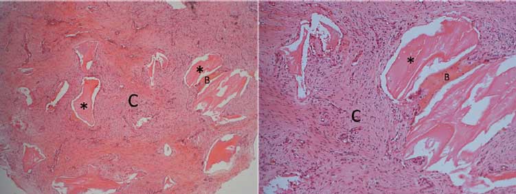 Figura 5 - Corte histológico de la zona trefinada. Presencia de remanente de biomaterial (*), recién formado trabéculas óseas (B) e tejido conectivo(C) de relleno. Coloración hematoxilina e eosina (HE). Aumento de 25x y 100x.