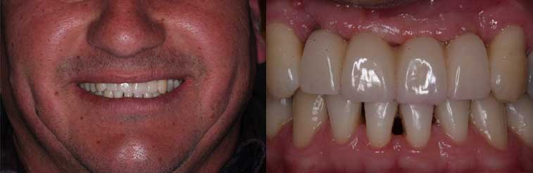 Figura 6 - Prótesis de implante de resina y la sonrisa del paciente después de la rehabilitación inicial.