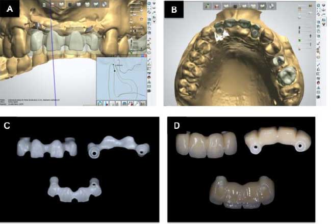 Figura 7 – (A, B, C, D) Planificación virtual para la fabricación de la nueva prótesis sobre implantes de cerámica por el sistema CAD-CAM.