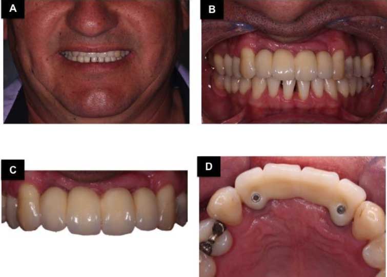 Figura 8 – (A, B, C, D) Control clínico después de 4,2 años.