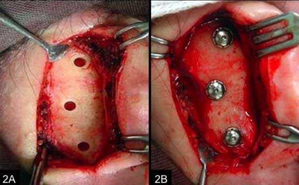 Figuras 2A y 2B. Fresado e colocación de los implantes