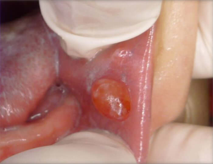 Fiura 1. Lesión tumoral de 1 cm de diámetro, de forma ovalada, eritematosa, con áreas blanquecinas, bordes regulares, base sésil, consistencia fluctuante, superficie lisa y brillante, ubicada en mucosa interna de carrillo izquierdo