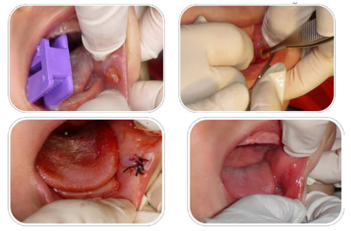 Figura 2. Secuencia del tratamiento, eliminaciónquirúrgica de la lesión, puntos de sutura, y post operatorio a los 7 días