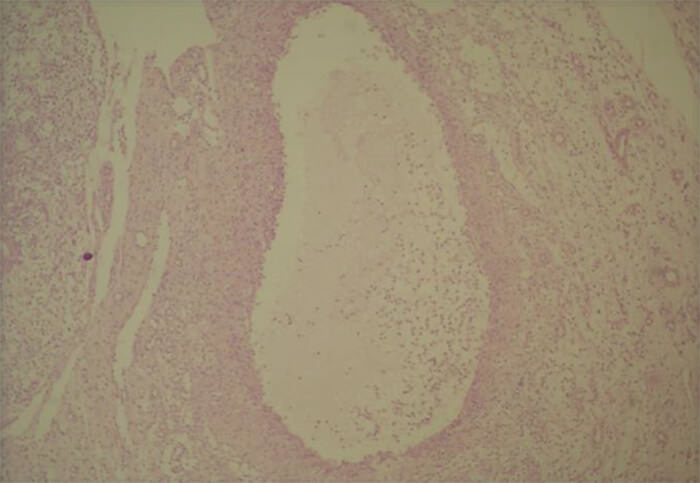 Figura 3. Cavidad rodeada de tejido de granulación (vasos sanguíneos, fibras colágenas e infiltrado inflamatorio crónico), en du interior se evidencia gran contenido de material mucoide (mucina) con presencia de células inflamatorias