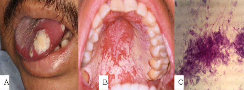 Figura #2: Lesiones de MB. Paciente masculino de 58 años de edad, con diagnóstico de leucemia aguda que desarrollo MB a los 7 días posteriores al inicio de la quimioterapia (A) Lesiones de CB. Paciente masculino de 29 años de edad, con diagnóstico de leucemia aguda, desarrollo candidiasis seudomembranosa en paladar duro (B). Confirmación del diagnóstico de infección por Candidaspp. con coloración de PAS (C). Fuente: Pacientes atendidos en el INCAM. Cortesía de la Dra. Velia Ramírez Amador.