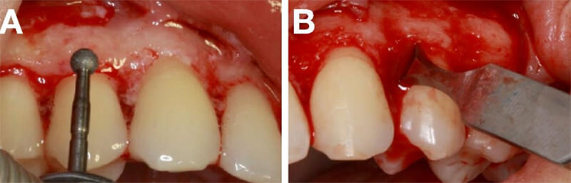 Figura  10.Remocion  de  tejido  oseo  con ayuda  de  limas,  cinceles  y  pieza  de  alta  rotación  que permite el proceso de osteotomía y osteoplastia.