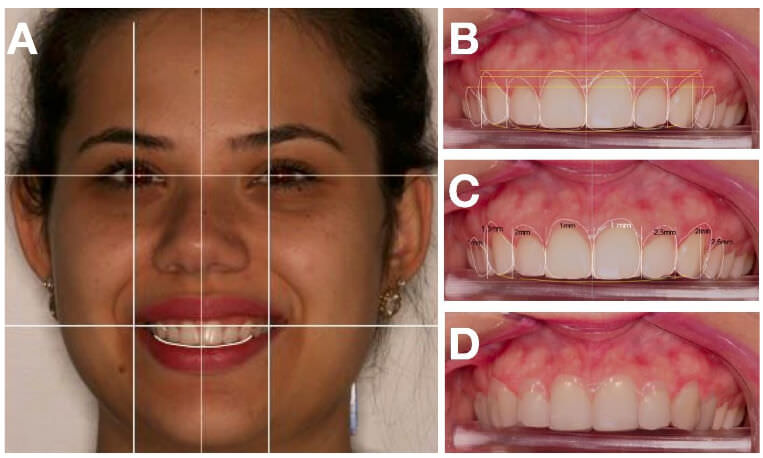 Figura  3. Líneas  de  referencias  para  la  cara  (A)  y  para  cada  elemento  dental  resultante  de  la planificación  digital  (B),  posibilitando  determinar  los  parámetros  para  la  confección  del  guía 
quirúrgico  y  la  medición  de  la  banda  de  encía que  deberá  ser  removida  durante  la  cirugía  (C), además de prever el resultado final del caso (D).