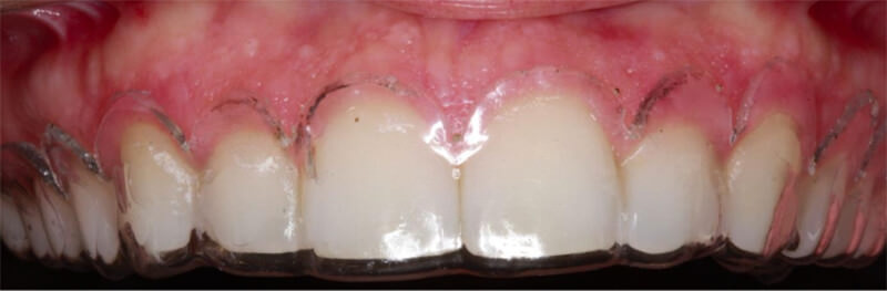 Figura 5. Colocación de  la guía quirúrgica después  de la colocación de  la anestesia, se visualiza el posicionamiento de la guía y la definición del límite cervical de referencia para la realización de la incisión del tejido gingival.