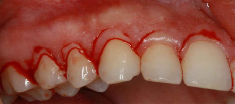 Figura 6. Imagen después de realizada la incisión en tejido gingival a bisel interno