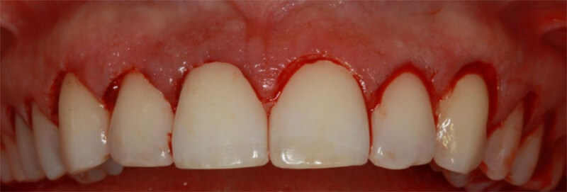 Figura 7. Aspecto  del  tejido  gingival  después  de  la  segunda  incisión  intrasurcular  y  retiro  del collarín gingival