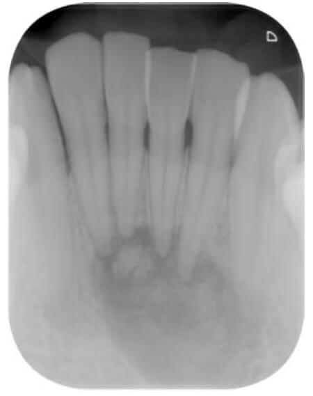 Figura 1: Displasia cemento-ósea – Etapa Osteolítica. Imagen radiográfica inicial en la que se observa zona radiolúcida alrededor de los ápices de los dientes de la región antero-inferior. También puede observarse el ligamento periodontal intacto en los dientes involucrados por la lesión y ausencia de resorción radicular.