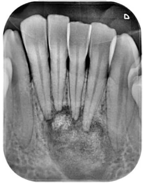 Figura 2: Control radiográfico de 1er año; displasia cemento-ósea – Inicio de la etapa Cementoblástica. La imagen radiográfica muestra el inicio de la mineralización de la zona radiolúcida de fibrosis por actividad cementoblástica aumentada, son evidentes la deposición de residuos de cemento. El ligamento periodontal permanece intacto en los dientes involucrados por la lesión.