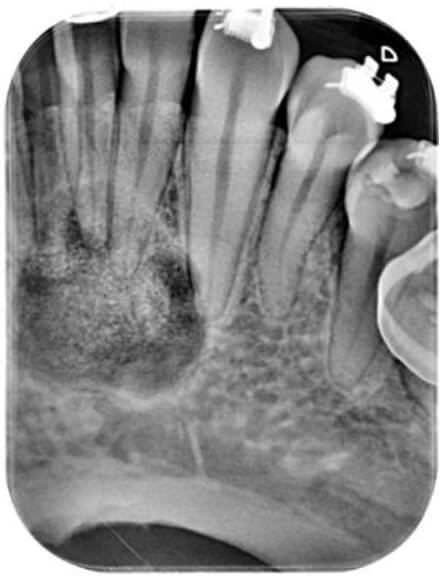 Figura 3: Control radiográfico del 2do año; displasia cemento- ósea, desarrollo de la fase cementoblástica. La imagen radiográfica muestra la formación de una masa radiopaca de mayor densidad y volumen en el centro de la lesión. El ligamento periodontal continua intacto en los dientes involucrados.