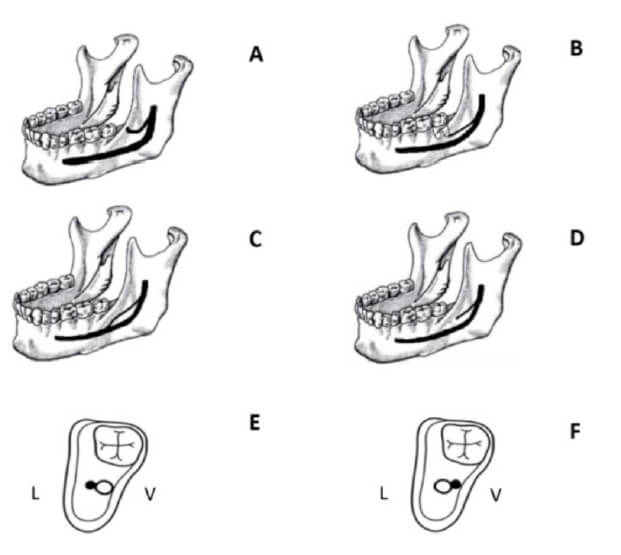 Fig. 1. Esquema de clasificación de Naitoh et al. Tomado de: Naitoh M, Nakahara K, Hiraiwa Y, Aimiya H, Gotoh K, Ariji E. Observation of buccal foramen in mandibular body using cone-beam computed tomography. Okajimas Folia Anat Jpn. 2009;86(1):25–9.