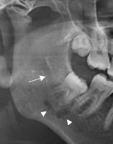 Fig. 2. Radiografía panorámica seccionada. Se señala el conducto alveolar inferior principal (flecha) y el conducto accesorio (cabeza de flecha).