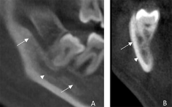 Fig. 3. A. Vista sagital: se observan ambos canales: principal (flecha) y accesorio (cabeza de flecha), pieza 48 en íntimo contacto con ambos conductos B. Vista transaxial: se observan ambos canales, pieza 48 en íntimo contacto con conducto principal. C. Vista coronal: se observan ambos conductos. D. Vista axial: se evidencia la salida ambos conductos por la tabla lingual.