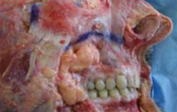 Fig 1. Anatomía topográfica de la bolsa adiposa de Bichat. Aparece entre el masetero y el maxilar, mientras que su extensión temporal puede verse justo encima del arco cigomático. Saban, Y. Polselli, R. Bertossi, D. East, C. Gerbault, O. Facial Layers and Facial Fat Compartments: Focus on Midcheek Area.