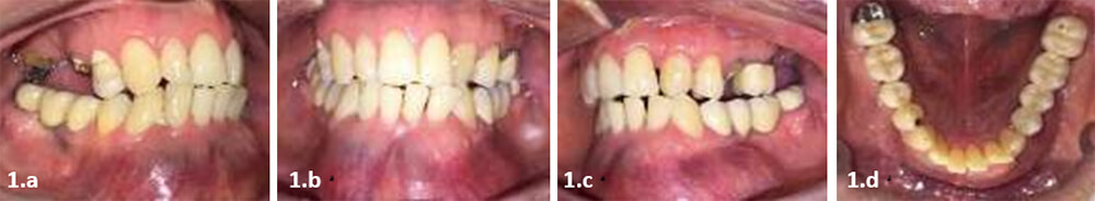 Figura 1. Fotografías intraorales. a) lateral izquierda. b) frontal. c) lateral derecha. d) oclusal inferior.