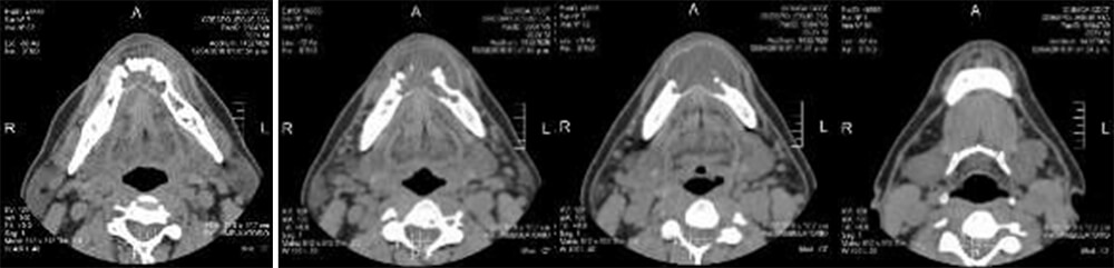 Figura 3. Tomografía volumétrica: cortes axiales secuenciales desde cefálico a caudal.