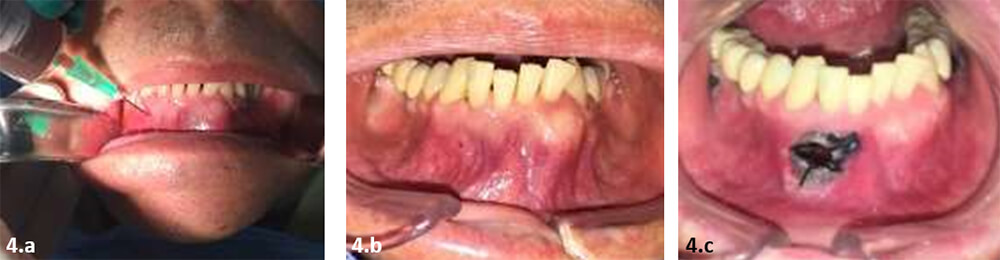 Figura 4. Fotografías trans operatorias, biopsia incisional. a) punción y aspiración. b) pérdida de volumen de la lesión. c) dispositivo de descompresión en posición.
